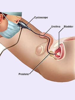 Cystoscopy