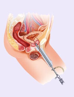 transurethral-resection-of-the-prostate-turp