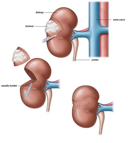 adrenalectomy