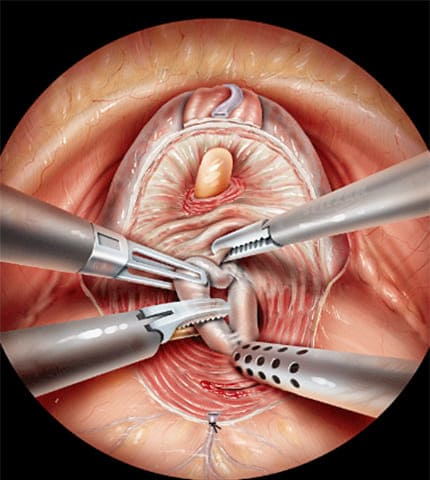 prostatectomy