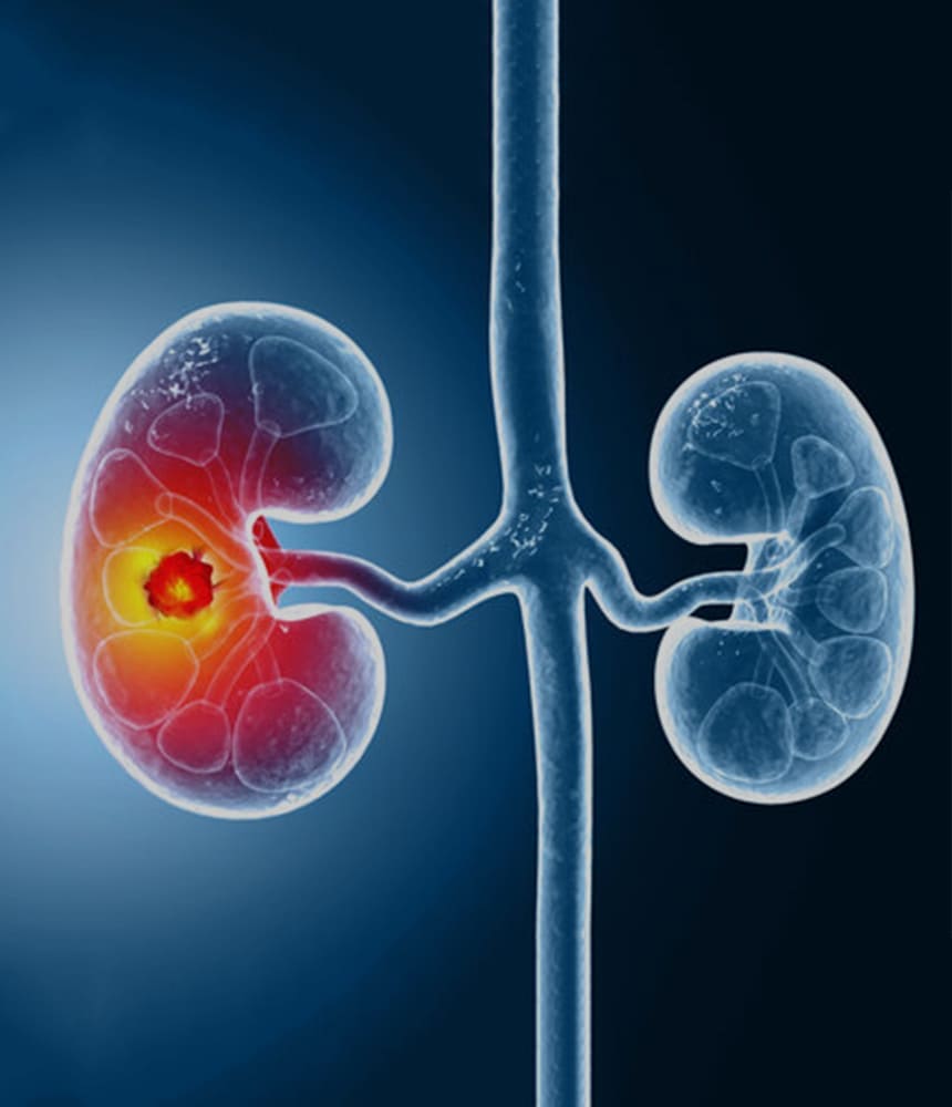 kidney-cancer