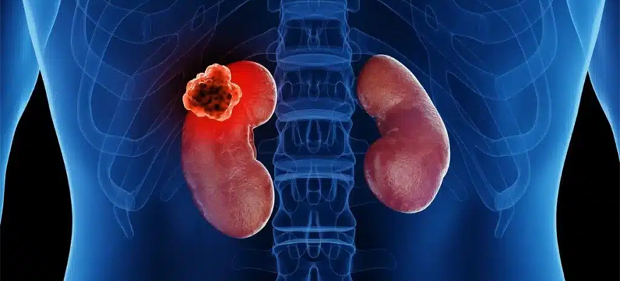 Kidney Cancer