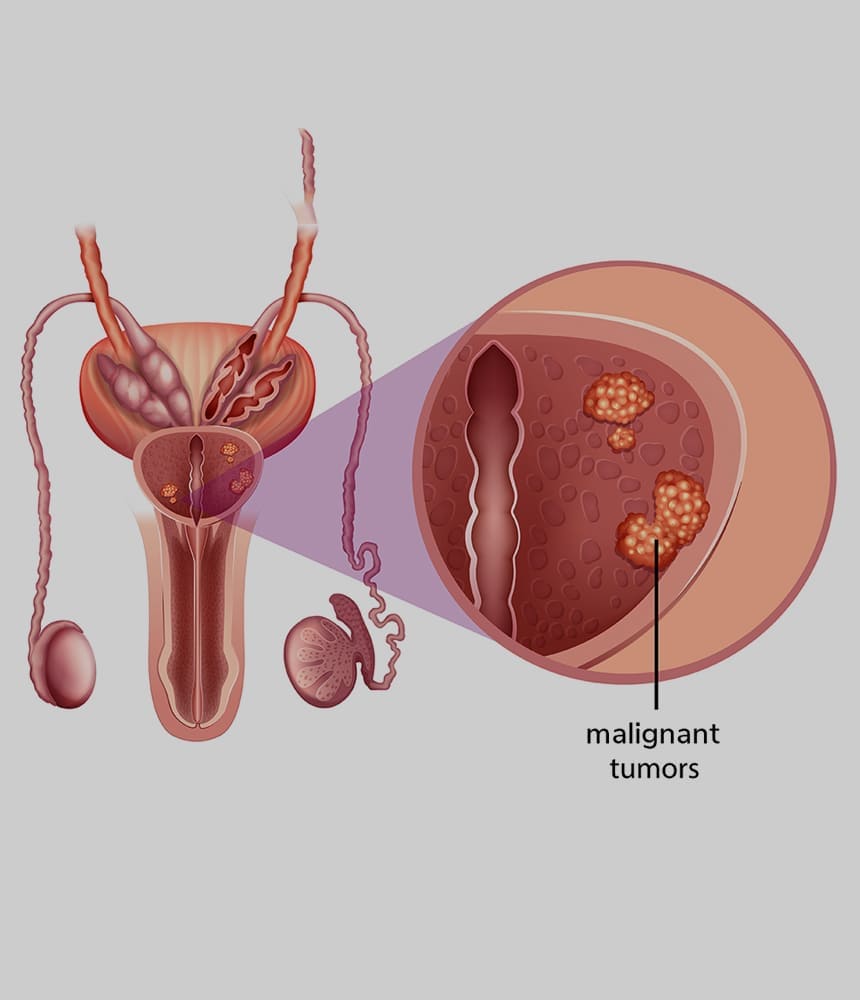 prostate-cancer