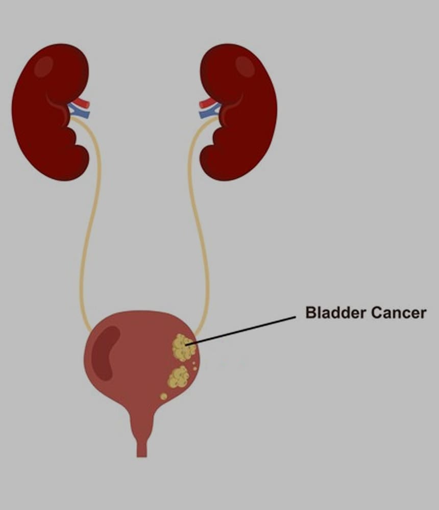 urinary-bladder-cancer